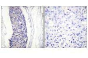 Immunohistochemistry analysis of paraffin-embedded human breast carcinoma tissue using Tubulin α antibody. (TUBA1A anticorps  (C-Term))