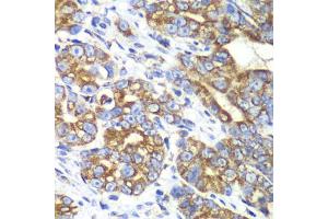 Immunohistochemistry of paraffin-embedded human gastric cancer using RALB antibody (ABIN6293713) at dilution of 1:100 (40x lens). (RALB anticorps)