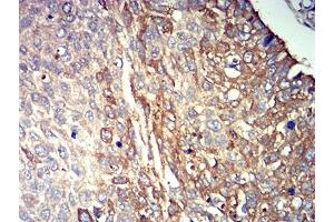 Immunohistochemical analysis of paraffin-embedded lung cancer tissues using P2RY14 mouse mAb with DAB staining.