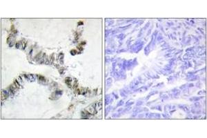 Immunohistochemistry analysis of paraffin-embedded human colon carcinoma, using SMF Antibody. (SNRPF anticorps  (AA 131-180))