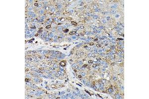 Immunohistochemistry of paraffin-embedded human esophageal cancer using PRC1 Rabbit pAb (ABIN6128502, ABIN6146124, ABIN6146125 and ABIN6222808) at dilution of 1:100 (40x lens).