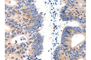The image on the left is immunohistochemistry of paraffin-embedded Human colon cancer tissue using ABIN7130064(LAT2 Antibody) at dilution 1/15, on the right is treated with fusion protein. (LAT2 anticorps)