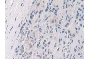 Detection of FKBP4 in Human Prostate cancer Tissue using Polyclonal Antibody to FK506 Binding Protein 4 (FKBP4)
