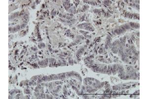 Immunoperoxidase of monoclonal antibody to FOXO3A on formalin-fixed paraffin-embedded human colon adenocarcinoma. (FOXO3 anticorps  (AA 361-460))