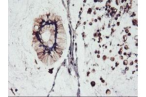 Immunohistochemical staining of paraffin-embedded Adenocarcinoma of Human colon tissue using anti-FBXO21 mouse monoclonal antibody. (FBXO21 anticorps)