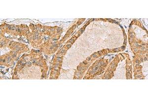 Immunohistochemistry of paraffin-embedded Human thyroid cancer tissue using PREPL Polyclonal Antibody at dilution of 1:55(x200) (PREPL anticorps)