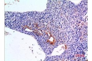 Immunohistochemistry (IHC) analysis of paraffin-embedded Human Liver Cancer, antibody was diluted at 1:100.