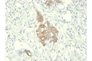 Formalin-fixed, paraffin-embedded human Breast Carcinoma stained with RET Mouse Monoclonal Antibody (RET/2795). (Ret Proto-Oncogene anticorps  (AA 702-848))