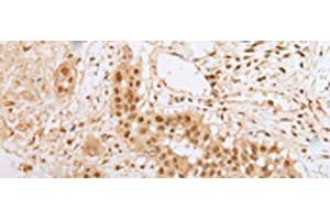 Immunohistochemistry of paraffin-embedded Human colorectal cancer tissue using ZNF22 Polyclonal Antibody at dilution of 1:25(x200)