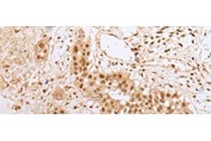 Immunohistochemistry of paraffin-embedded Human colorectal cancer tissue using ZNF22 Polyclonal Antibody at dilution of 1:25(x200) (Zinc Finger Protein 22 anticorps)