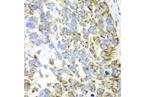 Immunohistochemistry of paraffin-embedded human esophageal cancer using CHIA antibody (ABIN5971776) at dilution of 1/100 (40x lens). (CHIA anticorps)