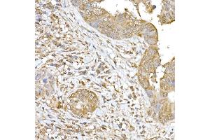 Immunohistochemistry of paraffin-embedded human colon carcinoma using SOCS1 Rabbit pAb (ABIN6128737, ABIN6148263, ABIN6148266 and ABIN6223700) at dilution of 1:250 (40x lens). (SOCS1 anticorps  (AA 1-211))