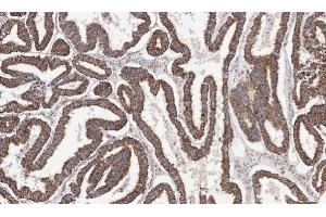 IHC-P Image Immunohistochemical analysis of paraffin-embedded human ovarian cancer, using ACADM, antibody at 1:100 dilution. (Medium-Chain Specific Acyl-CoA Dehydrogenase, Mitochondrial (C-Term) anticorps)