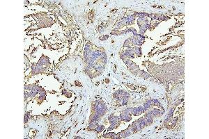 IHC analysis of CEACAM5 using anti-CEACAM5 antibody (ABIN7601435). (CEACAM5 anticorps  (AA 35-650))