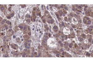 ABIN6273877 at 1/100 staining Human liver cancer tissue by IHC-P. (Prostaglandin D2 Receptor 2 (PTGDR2) (Internal Region) anticorps)