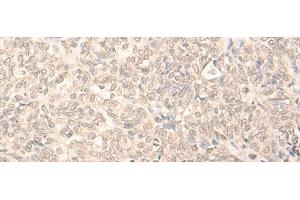 Immunohistochemistry of paraffin-embedded Human ovarian cancer tissue using RUVBL2 Polyclonal Antibody at dilution of 1:25(x200) (RUVBL2 anticorps)