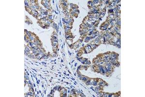 Immunohistochemistry of paraffin-embedded human gastric cancer using ATP5B antibody. (ATP5B anticorps  (AA 230-529))