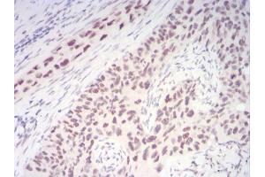Immunohistochemical analysis of paraffin-embedded cervical cancer tissues using CBX1 mouse mAb with DAB staining.