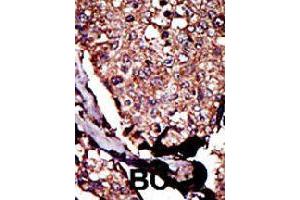 Formalin-fixed and paraffin-embedded human cancer tissue reacted with DGKB polyclonal antibody  , which was peroxidase-conjugated to the secondary antibody, followed by DAB staining. (DGKB anticorps  (C-Term))