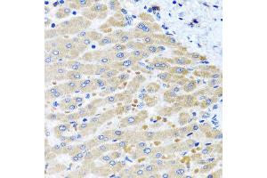 Immunohistochemistry of paraffin-embedded human liver injury using DARS2 antibody at dilution of 1:100 (x40 lens). (DARS2 anticorps)
