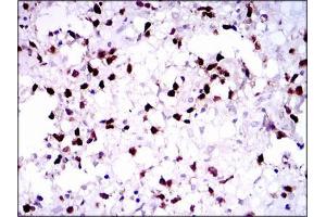 Immunohistochemical analysis of paraffin-embedded brain tumors tissues using PAX5 mouse mAb with DAB staining.