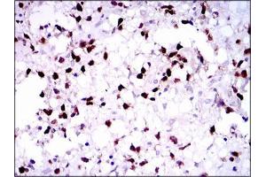 Immunohistochemical analysis of paraffin-embedded brain tumors tissues using PAX5 mouse mAb with DAB staining. (PAX5 anticorps  (AA 235-382))