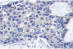 Immunohistochemistry (IHC) analyzes of p-ZAP-70 antibody in paraffin-embedded human breast carcinoma tissue. (ZAP70 anticorps  (pTyr493))