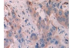 Detection of KRT6C in Human Breast cancer Tissue using Polyclonal Antibody to Keratin 6C (KRT6C) (Keratin 6C anticorps  (AA 163-482))