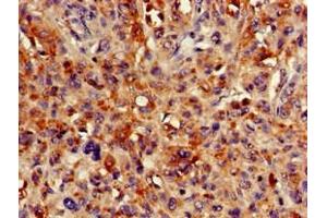 Immunohistochemistry of paraffin-embedded human melanoma using ABIN7163904 at dilution of 1:100