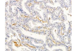 ABIN6263368 and ABIN6279540 at 1/100 staining human liver cancer by IHC-P. (MRPL33 anticorps  (Internal Region))