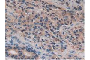 IHC-P analysis of Human Prostate Gland Cancer Tissue, with DAB staining. (FUCA1 anticorps  (AA 53-289))