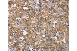 Immunohistochemistry of Human gastric cancer using CEACAM6 Polyclonal Antibody at dilution of 1:50 (CEACAM6 anticorps)