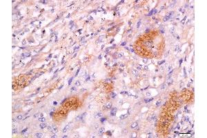 Formalin-fixed and paraffin embedded human lung carcinoma labeled with Anti-CD63/MLA1 Polyclonal Antibody, Unconjugated  at 1:200 followed by conjugation to the secondary antibody and DAB staining. (CD63 anticorps  (AA 101-200))