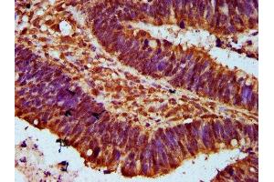 IHC image of ABIN7152566 diluted at 1:300 and staining in paraffin-embedded human ovarian cancer performed on a Leica BondTM system.