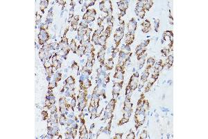 Immunohistochemistry of paraffin-embedded Human thyroid cancer using RPS18 antibody (ABIN6128660, ABIN6147205, ABIN6147206 and ABIN6215379) at dilution of 1:100 (40x lens). (RPS18 anticorps  (AA 1-152))