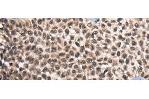 Immunohistochemistry of paraffin-embedded Human ovarian cancer tissue using CITED2 Polyclonal Antibody at dilution of 1:50(x200) (CITED2 anticorps)