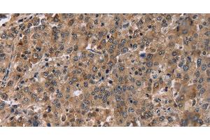 Immunohistochemistry of paraffin-embedded Human liver cancer tissue using FAM107A Polyclonal Antibody at dilution 1:30 (FAM107A anticorps)