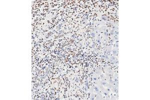 Immunohistochemical analysis of paraffin-embedded Human hepatocarcinoma tissue using (ABIN389547 and ABIN2839591) performed on the Leica® BOND RXm. (CREB1 anticorps  (pSer133))
