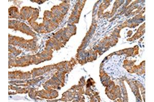 The image on the left is immunohistochemistry of paraffin-embedded Human esophagus cancer tissue using ABIN7193075(XKR4 Antibody) at dilution 1/20, on the right is treated with synthetic peptide. (XKR4 anticorps)