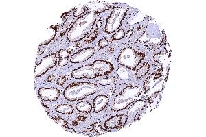 Prostatic adenocarcinoma Gleason 336 with intense nuclear MRE11 staining of tumor cells