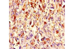 Immunohistochemistry of paraffin-embedded human melanoma using ABIN7147720 at dilution of 1:100