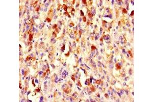 Immunohistochemistry of paraffin-embedded human melanoma using ABIN7147720 at dilution of 1:100 (CHD4 anticorps  (AA 1-219))