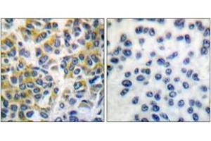 Immunohistochemistry analysis of paraffin-embedded human breast carcinoma tissue, using SHP-1 (Ab-536) Antibody. (SHP1 anticorps  (AA 502-551))
