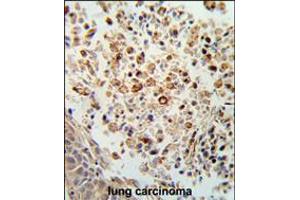 Formalin-fixed and paraffin-embedded human lung carcinoma reacted with FPRL2 Antibody , which was peroxidase-conjugated to the secondary antibody, followed by DAB staining. (FPR3 anticorps  (AA 307-333))