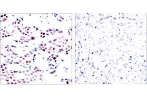 Immunohistochemistry analysis of paraffin-embedded human breast carcinoma, using c-Jun (Phospho-Thr91) Antibody. (C-JUN anticorps  (pThr91))