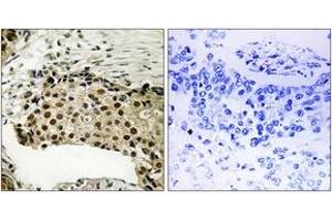 Immunohistochemistry analysis of paraffin-embedded human breast carcinoma, using MSK1 (Phospho-Ser212) Antibody. (MSK1 anticorps  (pSer212))