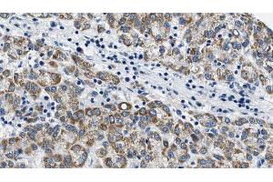 ABIN6274580 at 1/100 staining Human liver cancer tissue by IHC-P. (ADCY6 anticorps  (Internal Region))