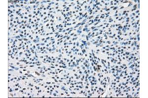 Immunohistochemical staining of paraffin-embedded Adenocarcinoma of colon tissue using anti-ZFP36 mouse monoclonal antibody.