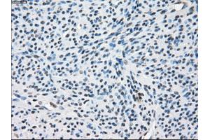 Immunohistochemical staining of paraffin-embedded Adenocarcinoma of colon tissue using anti-ZFP36 mouse monoclonal antibody. (ZFP36 anticorps)
