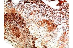 Immunohistochemical analysis of paraffin-embedded Human Lung Carcinoma Tissue using Collagen II Mouse mAb diluted at 1:200. (COL2A1 anticorps)